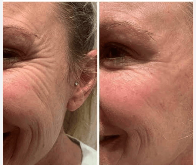Aparelho[Revitalizador Facial] Anti Rugas - Pechinchas Daweb